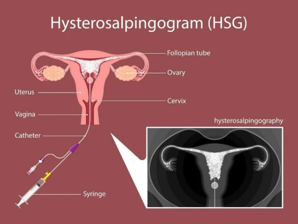 painless HSG test in Kolkata