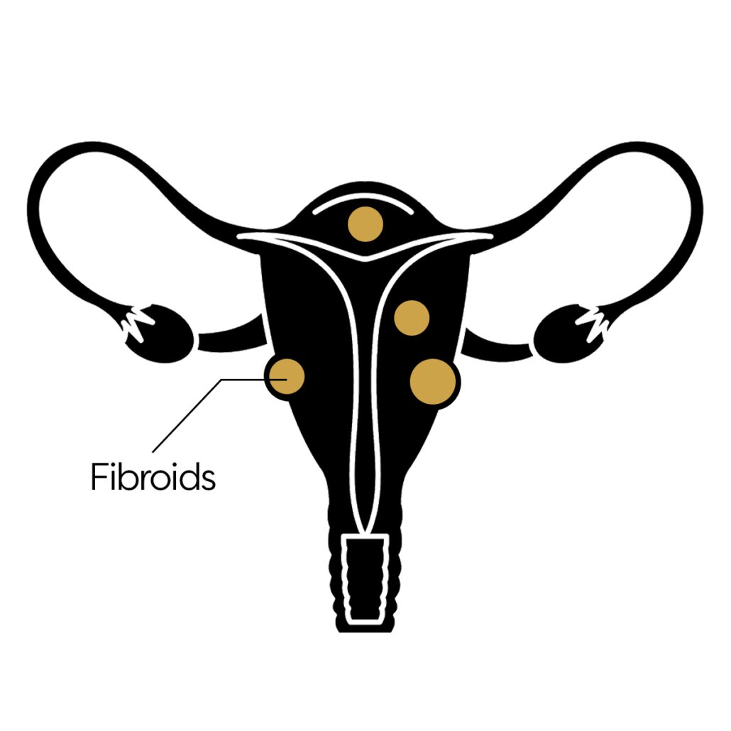 PCOS Management
