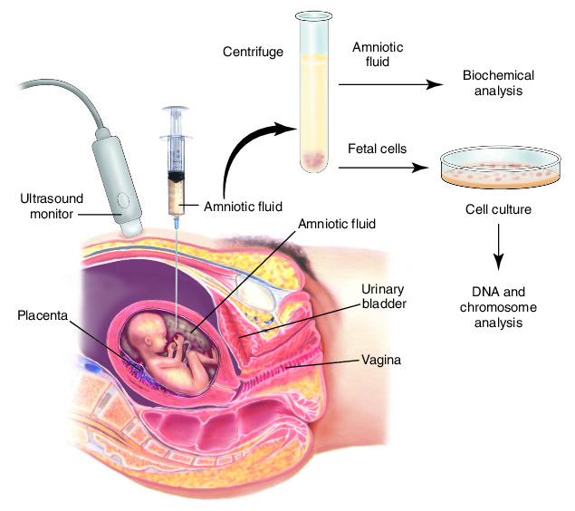 Amniocentesis test in Kolkata — step-by-step medical illustration at IHR IVF
